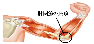 肘関節の圧迫